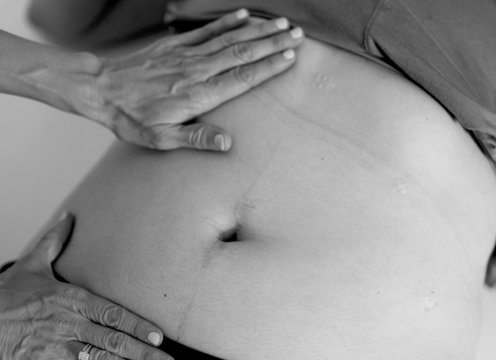 closeup of a woman's stomach, a PTs hands are placed on top of her ribs and her hip bones. You can see scars consistent with endometriosis surgery on her abdomen